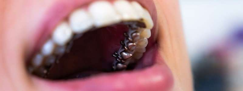 lingual-ortodonti-tedavisi-istanbul