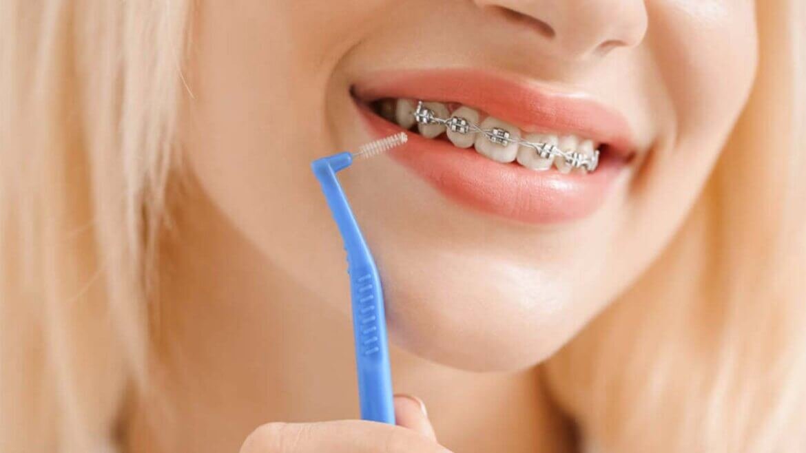 Diş Teli Tedavisi ve Sonrası