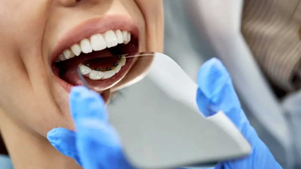 Lingual Ortodonti (Görünmeyen Diş Teli) Tedavisi