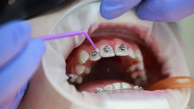 Ortodonti Tedavisine Kaç Yaşında Başlanmalı?